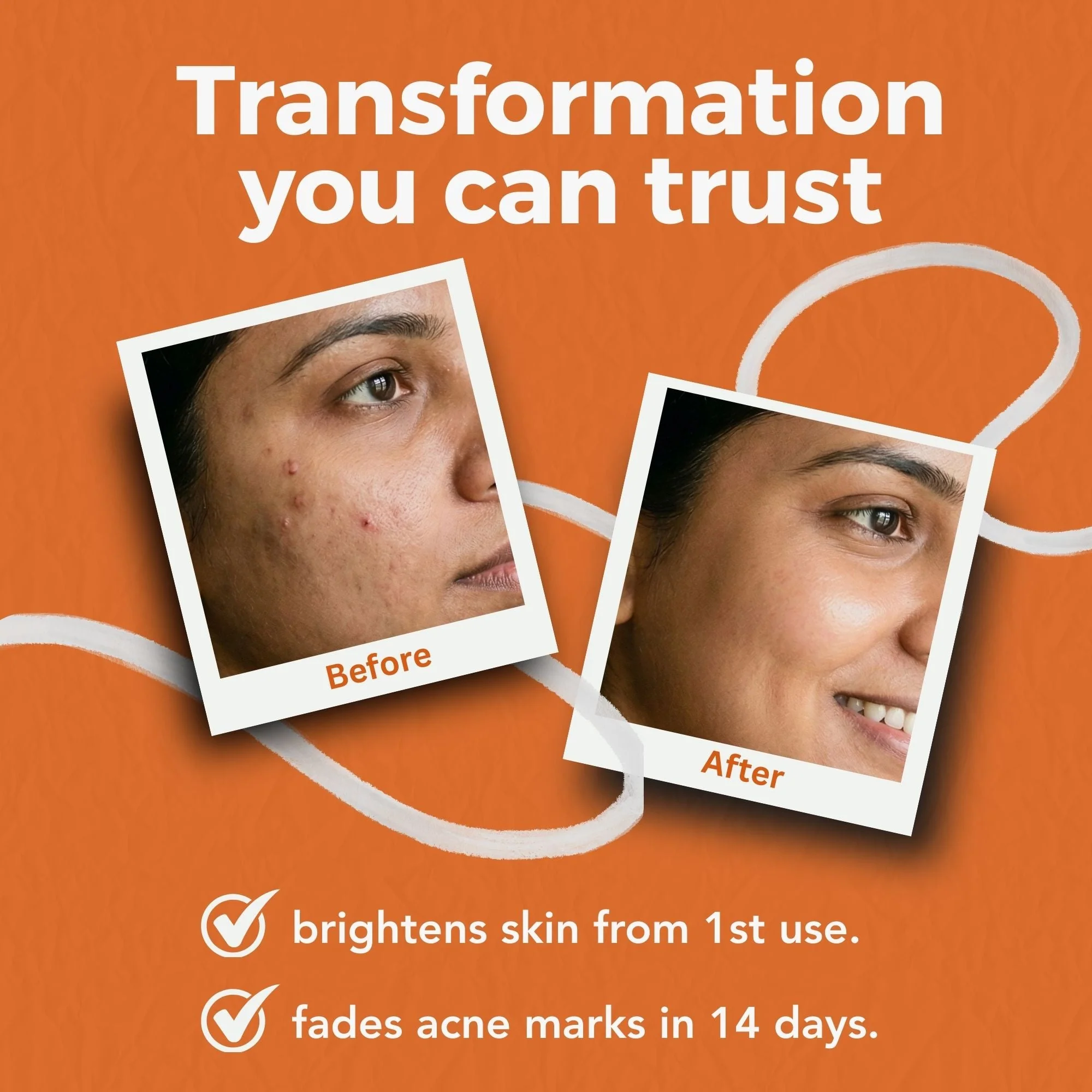 Active Acne and Pigmentation 2 Step Serum Combo - Image 3