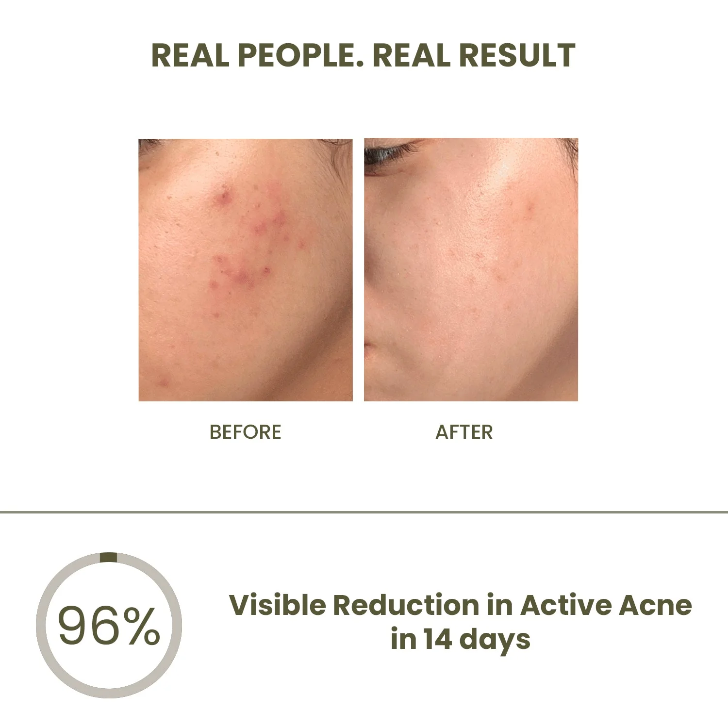 Anti-Acne & Pimple Set - Image 8