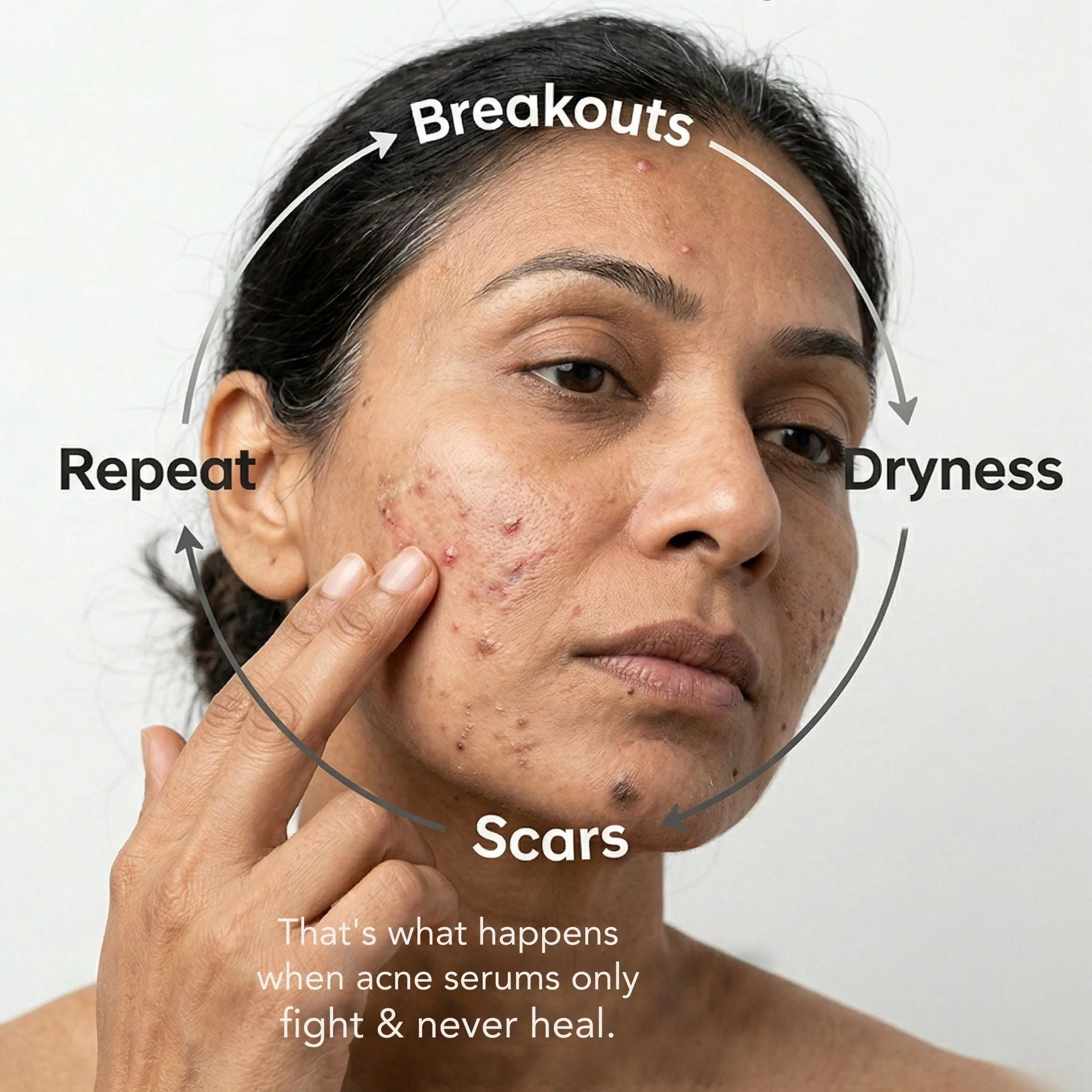 Mild Acne 2-Step Starter Regime Facewash & Serum Combo - Image 4