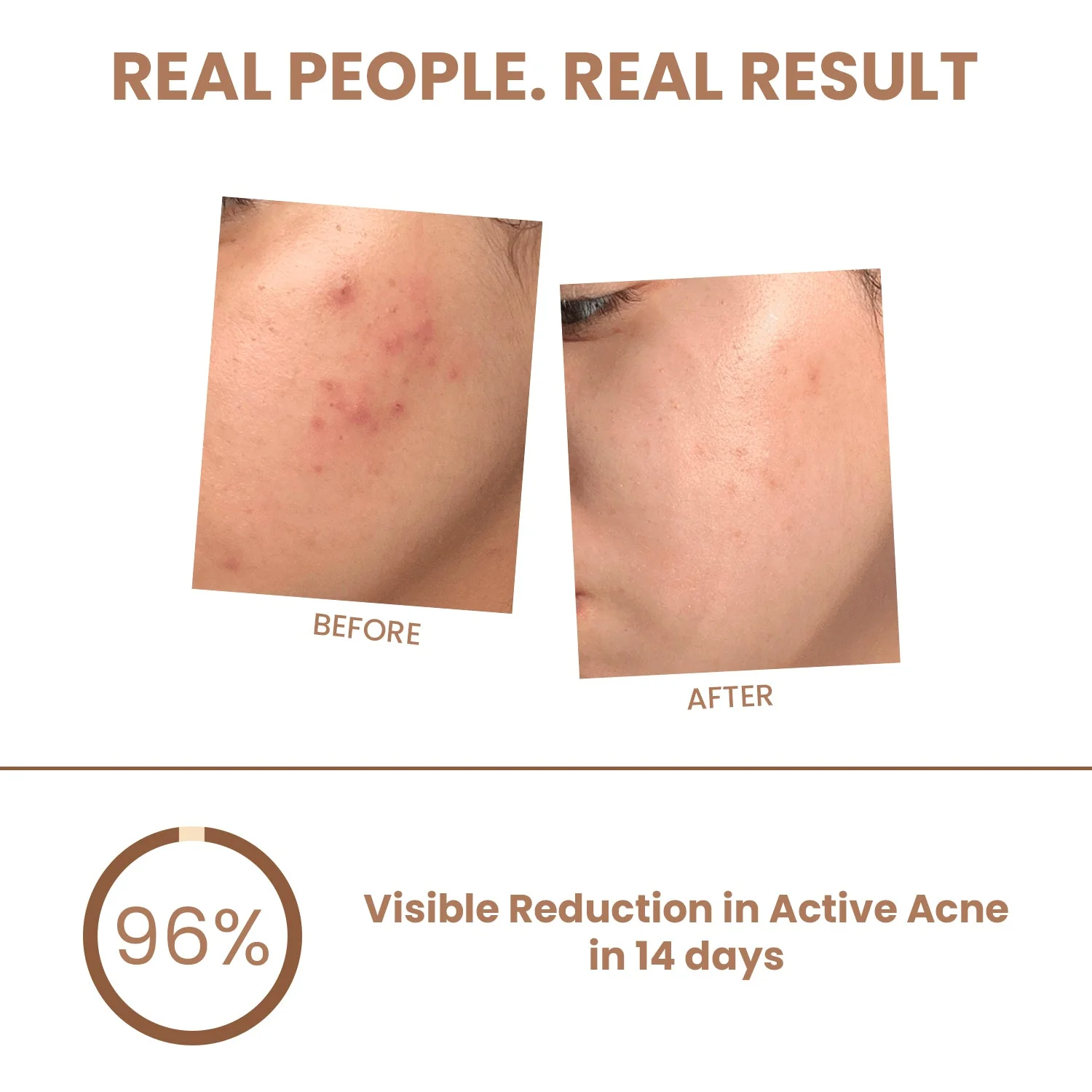 Pimple & Acne Corrector Gel - Image 4